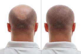 Hair Transplant in Dubai